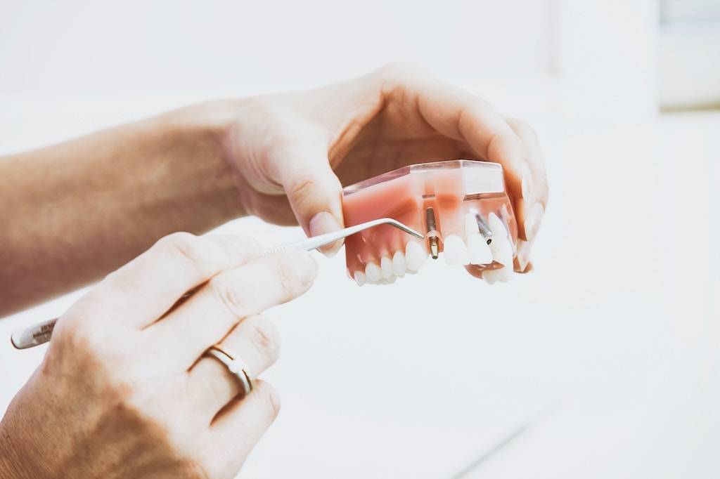 Does Dental Insurance Cover Implants