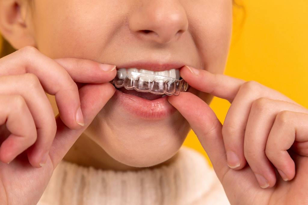 Does insurance cover Invisalign?