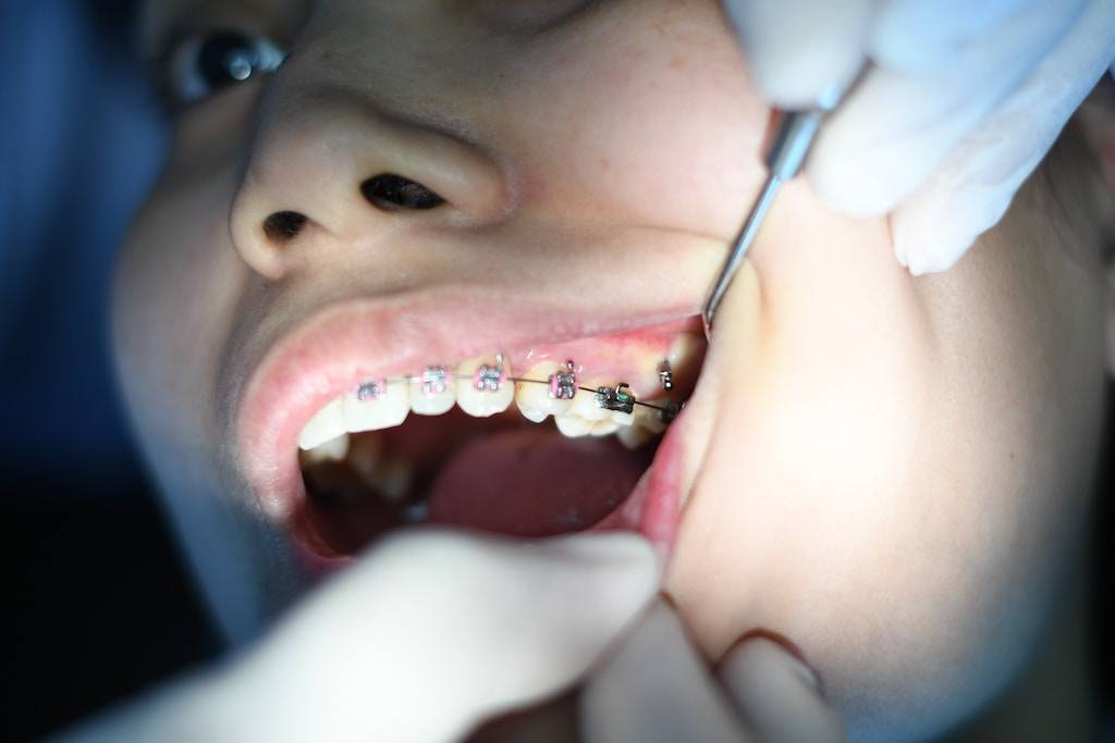 How to Determine the Cost of Braces with Insurance
