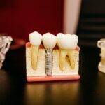 The Cost of a Fake Tooth with Insurance