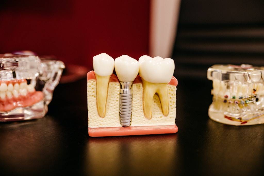 The Cost of a Fake Tooth with Insurance