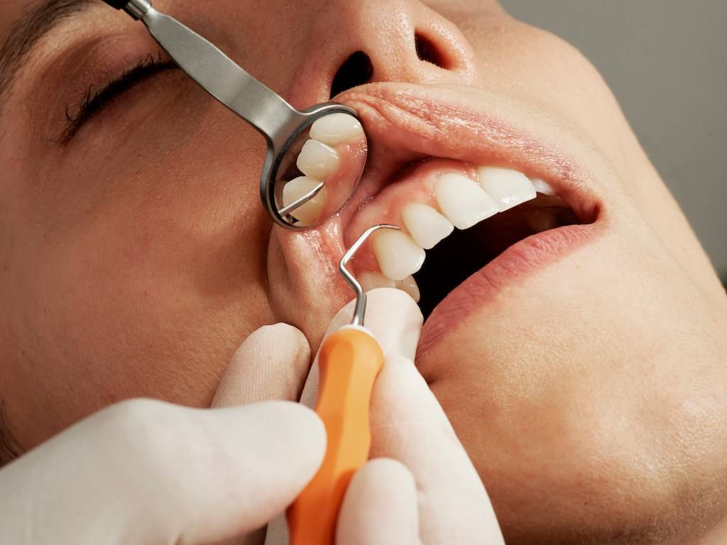 The Cost of Dental Cleaning Without Insurance