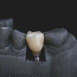 What is the cost of a dental bridge with insurance?