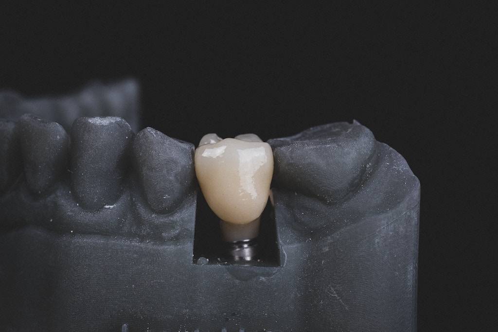 What is the cost of a dental bridge with insurance?